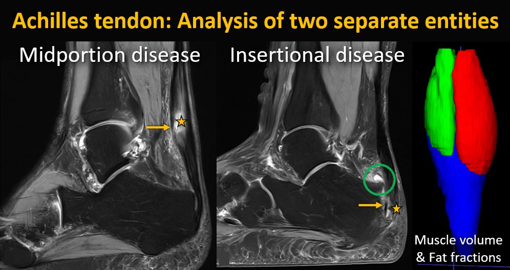 SutterBalgrist's tweet image. #Achilles tendon disease comes in two entities: Read our analysis for free👉link.springer.com/article/10.100…
#Midportion disease:
More severe tendon thickening & complete tears
#Insertional disease:
Partial tears more frequent
@derbalgrist @skeletaljournal @sophiasamira92 #MSKrad