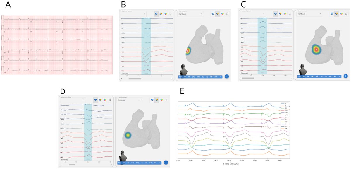 Heart Rhythm Case Reports (@hrs_casereports) on Twitter photo First Demonstration of Left Bundle Branch Area Pacemaker Implantation Guided by Artificial Intelligence ECG Mapping
<a href="/DrKrummenEP/">David Krummen</a>, @omar_aldaas, <a href="/UCSDCardiology/">UC San Diego Cardiology</a>
heartrhythmcasereports.com/article/S2214-… First Demonstration of Left Bundle Branch Area Pacemaker Implantation Guided by Artificial Intelligence ECG Mapping
<a href="/DrKrummenEP/">David Krummen</a>, @omar_aldaas, <a href="/UCSDCardiology/">UC San Diego Cardiology</a>
heartrhythmcasereports.com/article/S2214-…