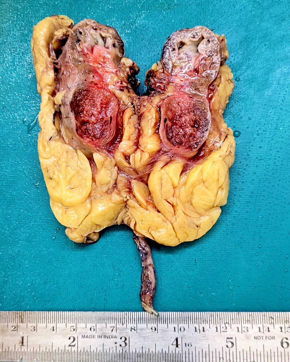 megha_lalcheta's tweet image. Small and atrophic kidney with mass in the lower pole!

#RenalPath #GrossPath #Pathology #Oncopath #PathX #Pathtwitter #Pathresidents #Kidney