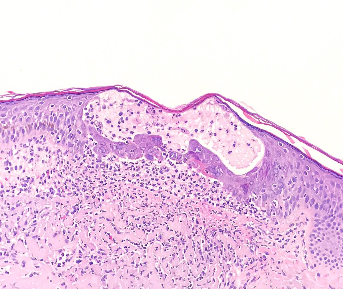 Skin biopsy. A pathology classic. One pic only. 
Answer ✅ youtu.be/yfs42lmFZfU
#pathology #pathologists #pathTwitter #dermpath #dermatology #dermatologia #dermtwitter #usmle