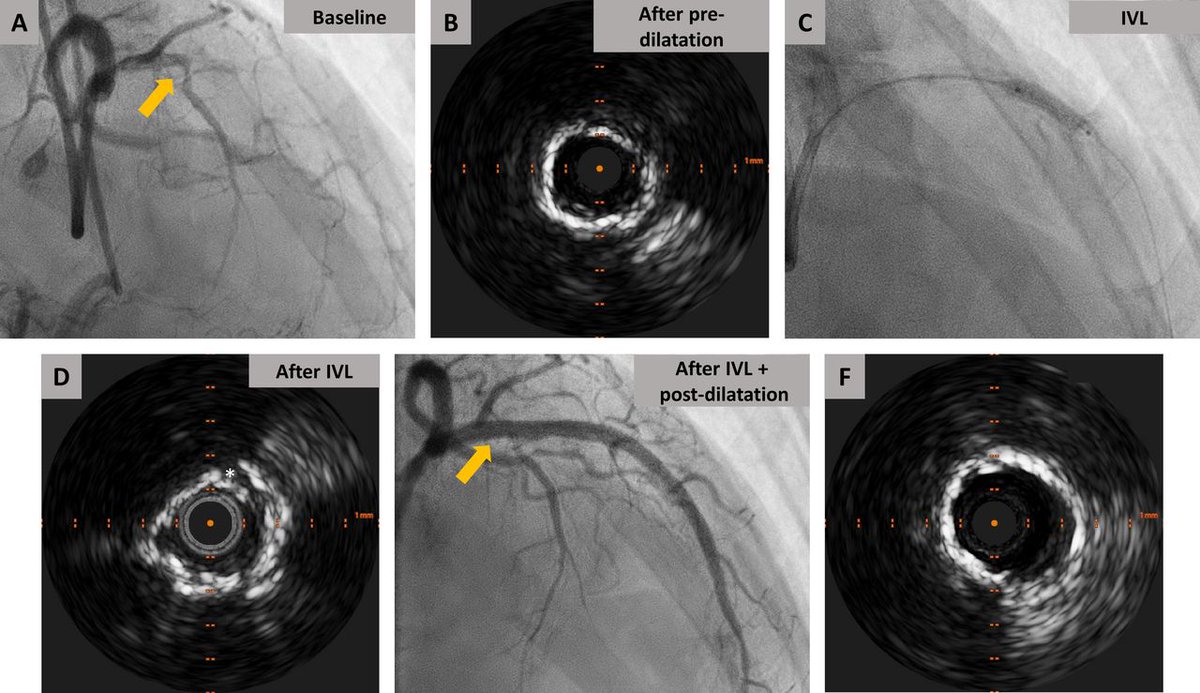 Heart_BMJ's tweet photo. Evolving use and clinical outcomes of coronary intravascular lithotripsy: insights from an international, multicentre registry  https://t.co/zrjEplMzjQ https://t.co/PRok78G6yH