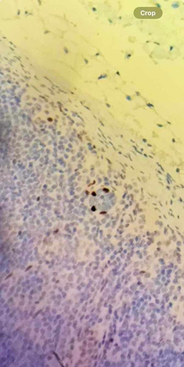 A cute epithelial inclusion in an lymph node from a patient with DCIS. 

p63 worked beautifully on this one 🥰 

#Breastpathology