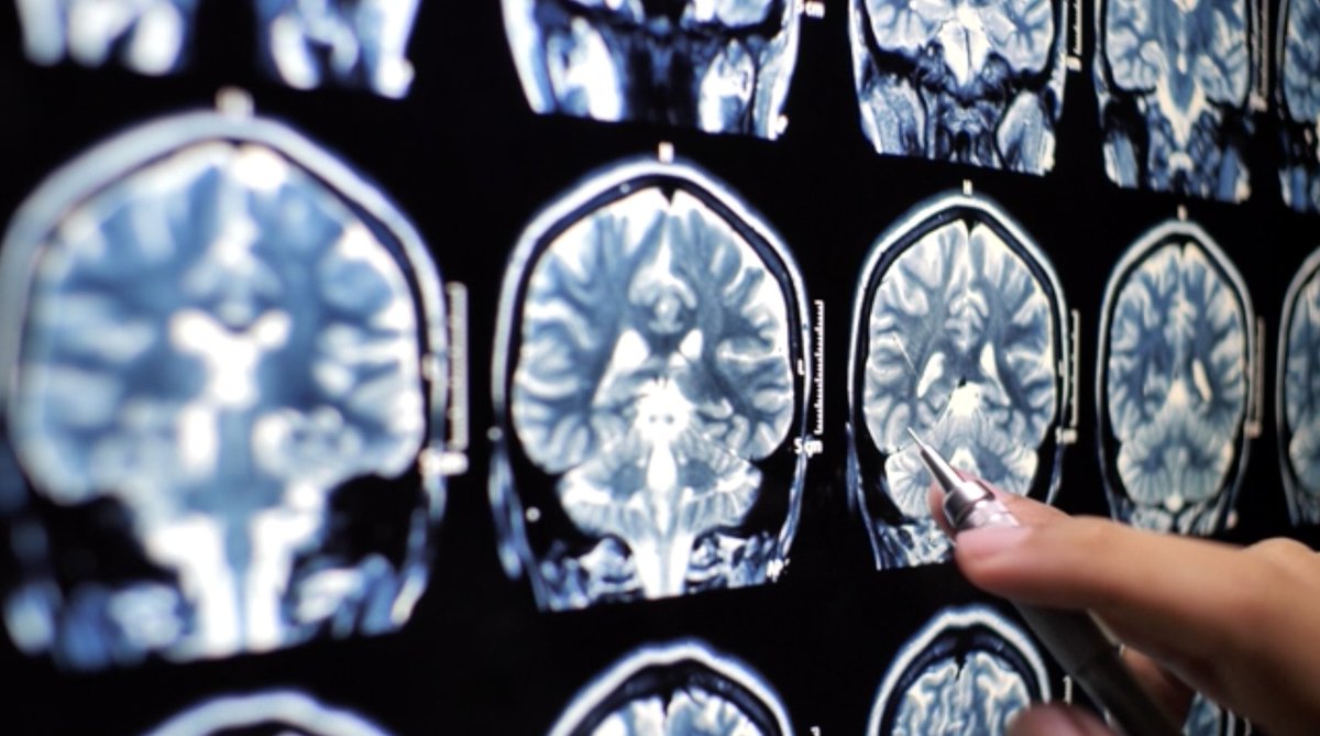 Groundbreaking research on autosomal dominant leukodystrophy (ADLD) is unlocking key insights into this rare neurodegenerative disease. Mayo Clinic is paving the way for earlier diagnoses, clinical trials &amp; genetic therapies. Learn more: mayocl.in/3E1Z8b4