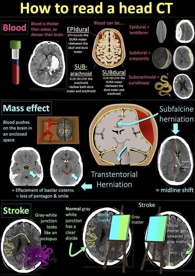 🔴 How to Read A Head CT ✨
 🌷🌷🌷 The 3 main things to look for are:
    🔸Blood
    🔸Mass Effect
    🔸Stroke

➡️Blood
🔸CT is just a measure of density.  Blood is thicker than water, so blood is denser than brain (70% water) on head CT