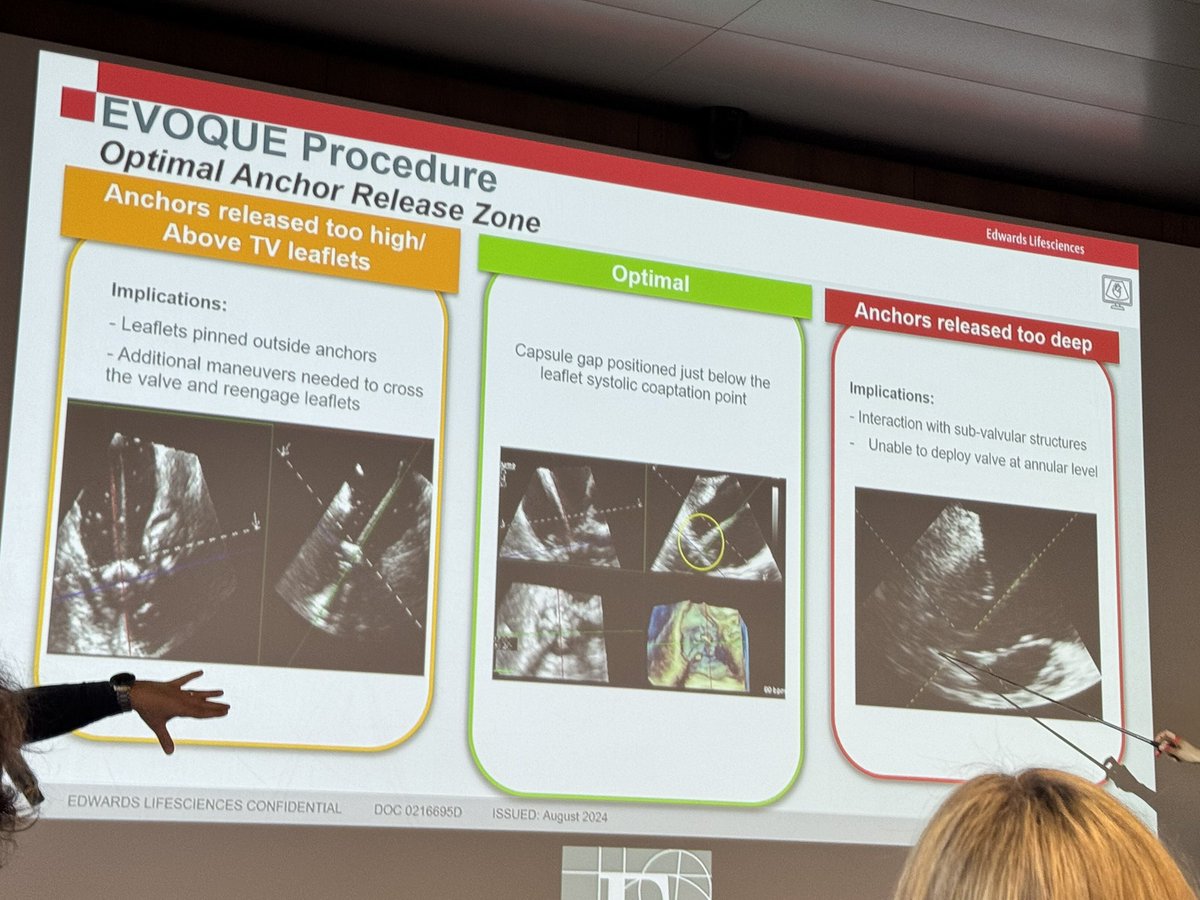 Belén Cid Alvarez (@belcid7) on Twitter photo Excited to start the Evoque tricuspid valve implantation programme in Santiago <a href="/cardiologiaCHUS/">CARDIOCHUS</a> <a href="/MonzonisAmparo/">Amparo Martinez Monzonis</a> <a href="/JoseJuanatey/">José R. Juanatey</a> #MelisaSantás
<a href="/AlfredoRedondoD/">Alfredo Redondo</a> <a href="/GestalRoma88655/">Santi</a> <a href="/monlago1/">Mon Lago</a> Excited to start the Evoque tricuspid valve implantation programme in Santiago <a href="/cardiologiaCHUS/">CARDIOCHUS</a> <a href="/MonzonisAmparo/">Amparo Martinez Monzonis</a> <a href="/JoseJuanatey/">José R. Juanatey</a> #MelisaSantás
<a href="/AlfredoRedondoD/">Alfredo Redondo</a> <a href="/GestalRoma88655/">Santi</a> <a href="/monlago1/">Mon Lago</a>