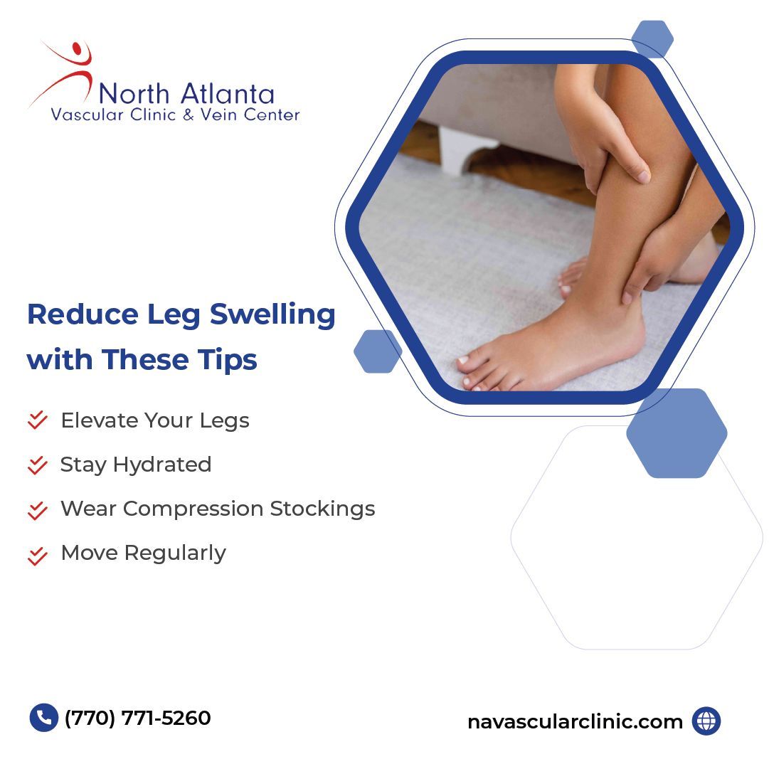 northatlanatva1's tweet image. Swollen legs? It could be poor circulation. Follow these simple steps to improve blood flow and reduce discomfort!
#HealthyLegs #CirculationMatters #NorthAtlantaVascularClinic