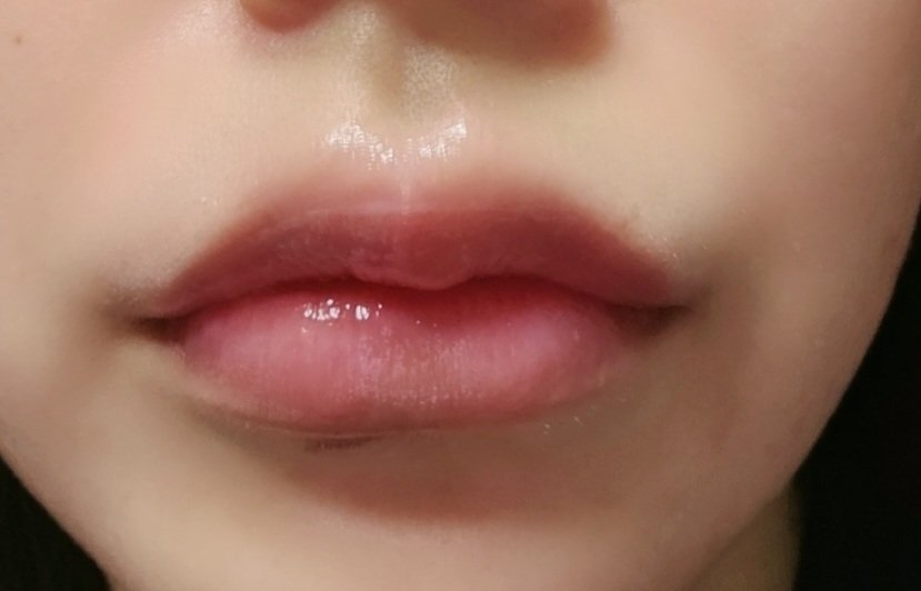 decohirochan's tweet photo. どんなデザインがいいか写真ありますか？って聞かれたけど何も見せずゆるいMで口角はキュッとでお任せしました！
1週間たって落ち着いてむにっとぽってり👄になった☺️通訳さんがパスポート確認して27歳くらいかと思ったって言ってくれたことが一番嬉しかった🤣 https://t.co/gnDwgOBLrn