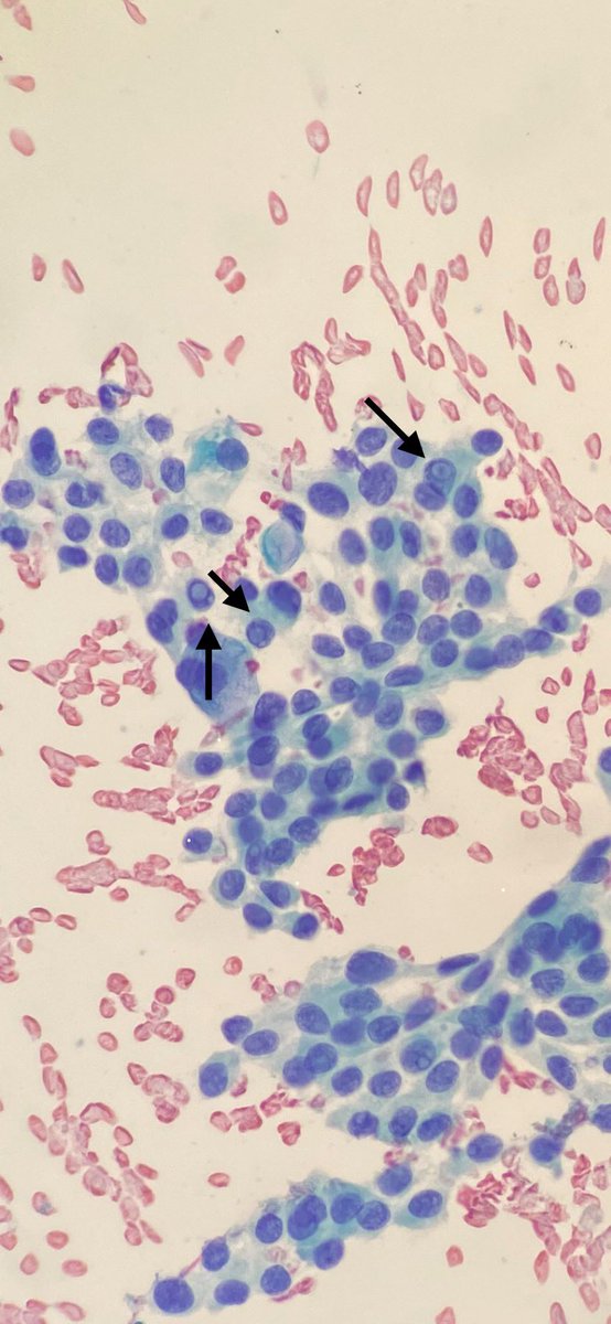 Younesaljo's tweet photo. Thyroid 
 - Intranuclear inclusions
- Papillary thyroid carcinoma(PTC) 
#cytology #cytopath #PathTwitter https://t.co/pQFb2BNMCg