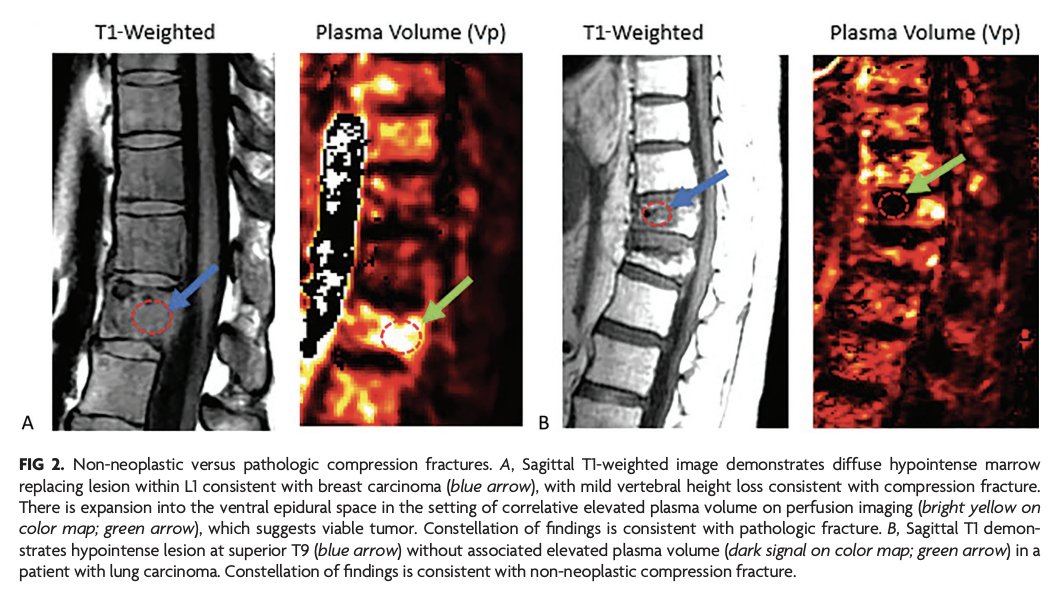 AJNR (@theajnr) on Twitter photo "Comprehensive Review of the Utility of Dynamic Contrast-Enhanced MRI for the Diagnosis and Treatment Assessment of Spinal Benign and Malignant Osseous Disease"
doi.org/10.3174/ajnr.A…
<a href="/The_ASSR/">American Society of Spine Radiology (ASSR)</a> <a href="/AtinSaha/">Atin Saha, MD, MS</a> "Comprehensive Review of the Utility of Dynamic Contrast-Enhanced MRI for the Diagnosis and Treatment Assessment of Spinal Benign and Malignant Osseous Disease"
doi.org/10.3174/ajnr.A…
<a href="/The_ASSR/">American Society of Spine Radiology (ASSR)</a> <a href="/AtinSaha/">Atin Saha, MD, MS</a>