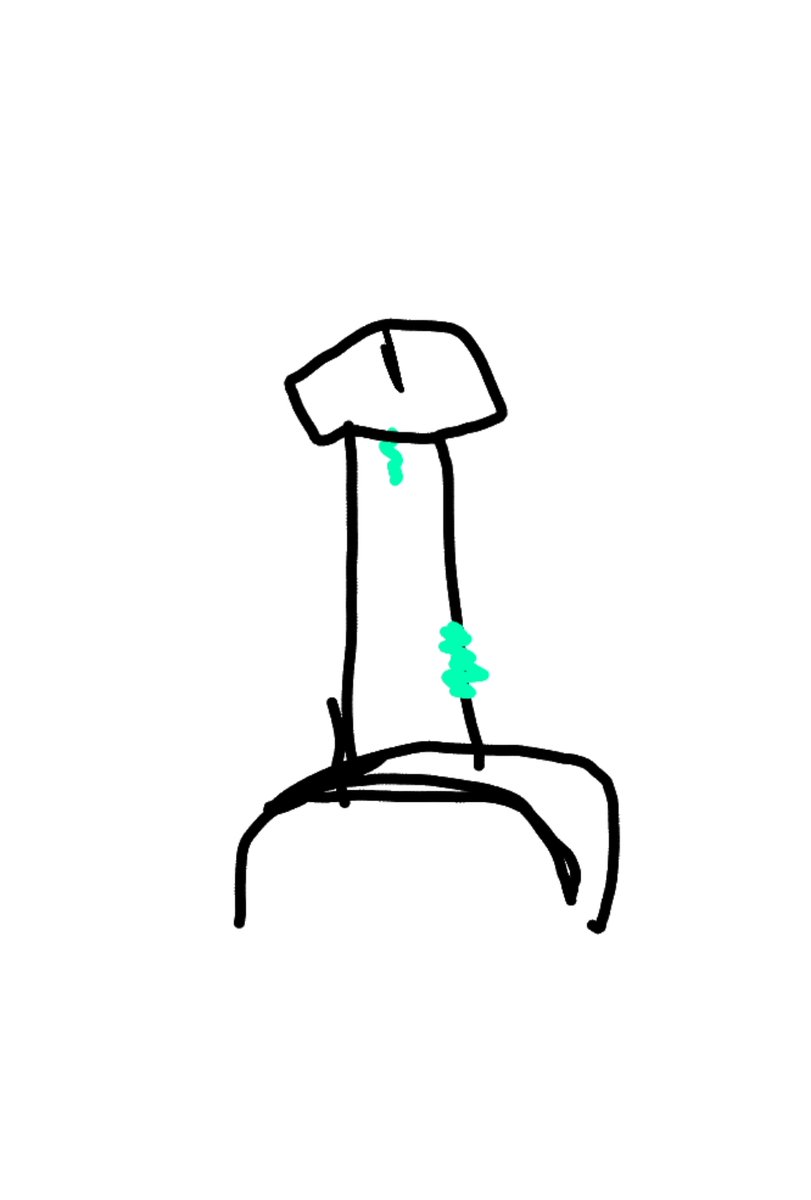 I pressed my penis when it was erect from the head to inside and it hasn't yet healed. It's been almost a year. It got also broken after aggressive masturbation. It should get stitched but I can't get help. 

So now it's broken from 2 places.