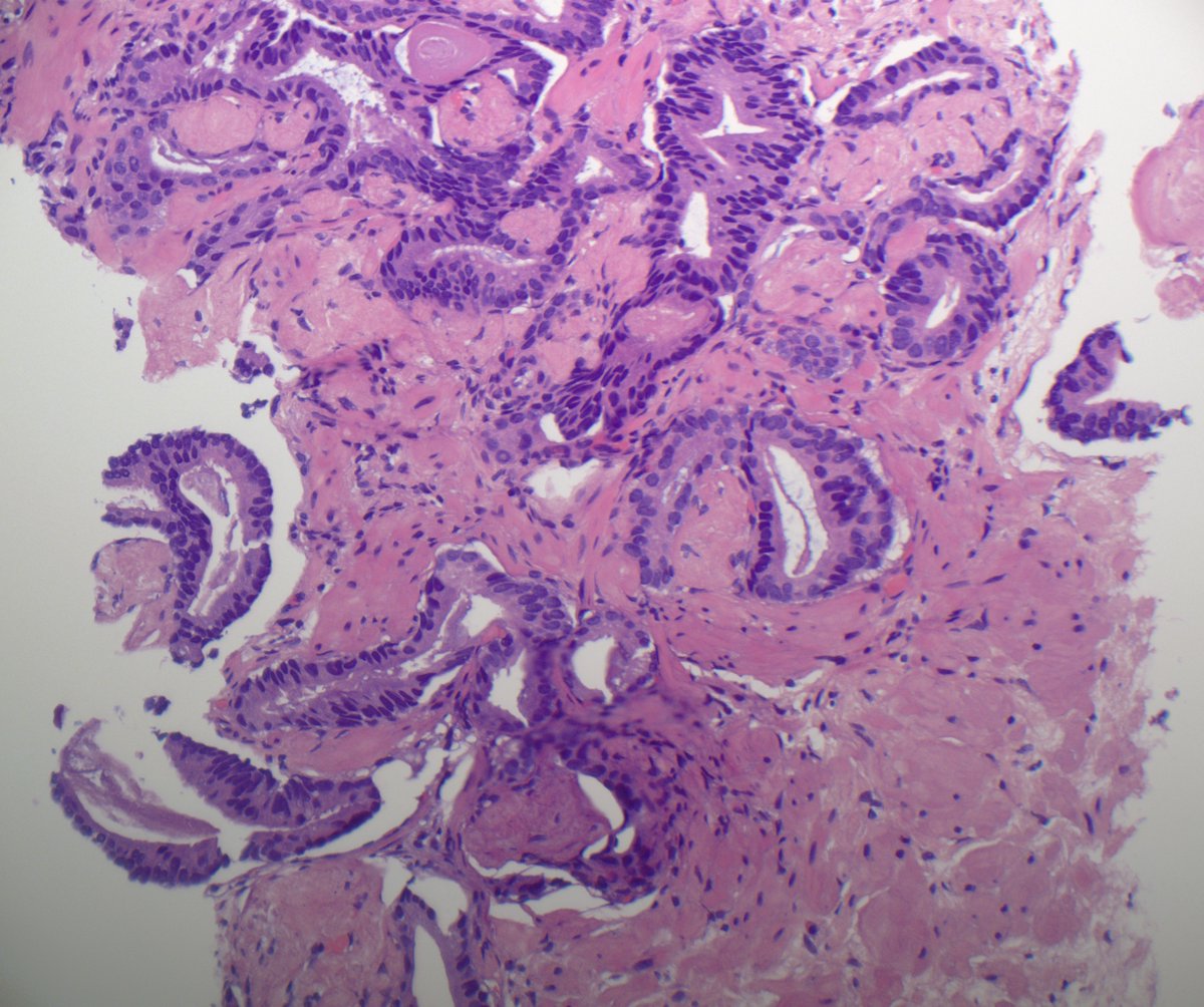 slusagar's tweet photo. it's a bird, it's a plane, it's perineural invasion....

NO!  it's mucinous fibroplasia!  a very good🔬clue for prostate cancer!
(grading is easier said than done..."subtract off mucinous fibroplasia and grade underlying architecture"😅)

#GUpath #prostatebx https://t.co/t6u349n6Tg