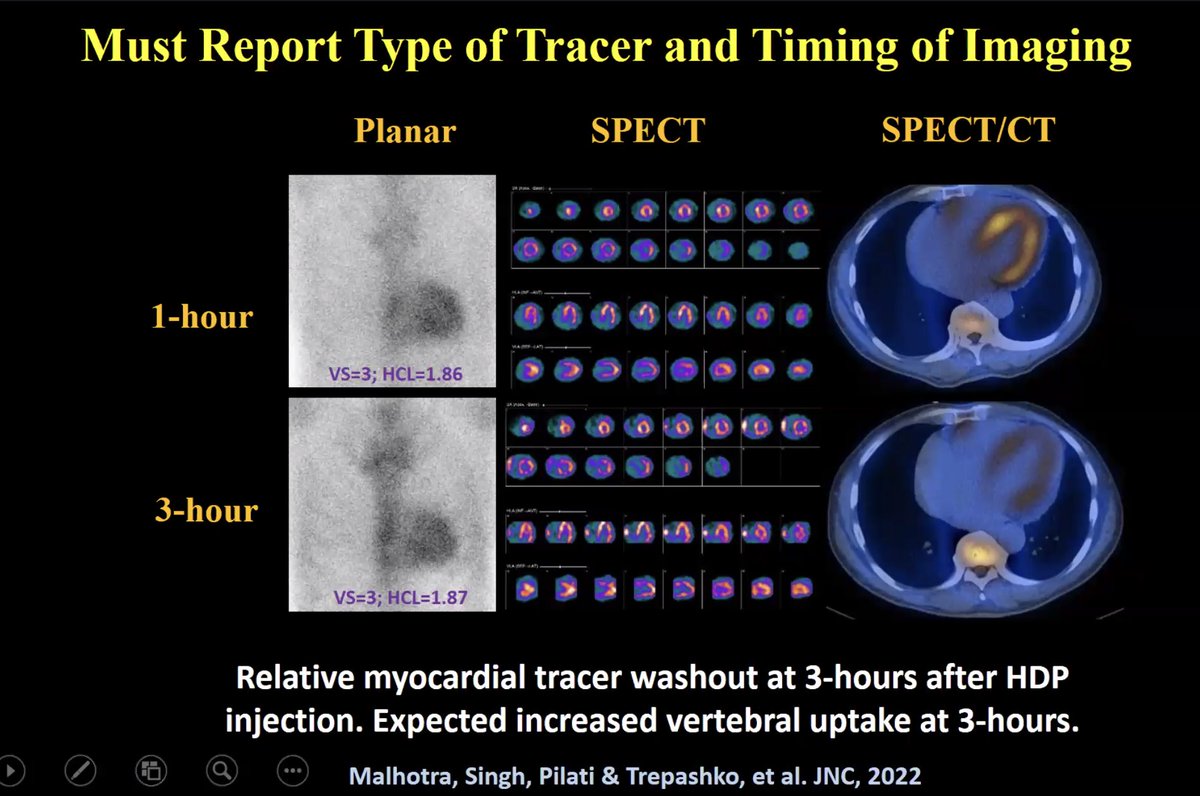 A.Sami Abuzaid MD,EMHL,FASE,FSCCT,FSCMR,FESC,FACC (@aabuzaiddr) on Twitter photo 3 hour imaging with HMDP can lead to false negative scan for ATTR amyloidosis <a href="/MyASNC/">ASNC Society</a> <a href="/NotNoninvasive/">Saurabh Malhotra</a> 3 hour imaging with HMDP can lead to false negative scan for ATTR amyloidosis <a href="/MyASNC/">ASNC Society</a> <a href="/NotNoninvasive/">Saurabh Malhotra</a>