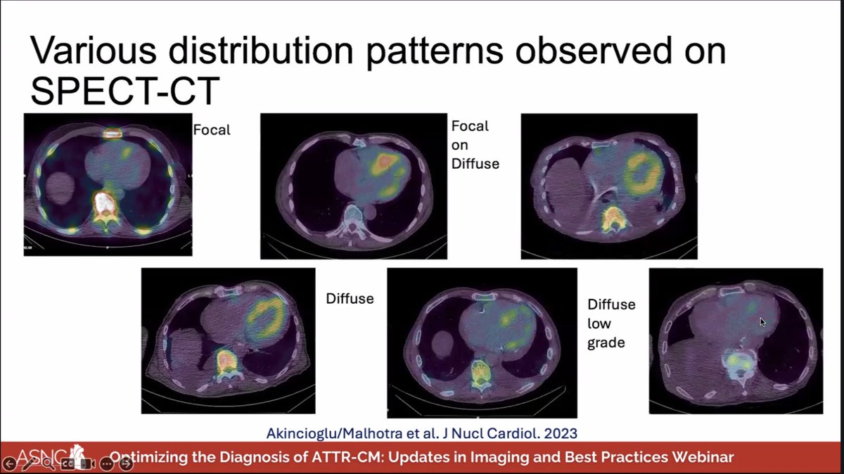 A.Sami Abuzaid MD,EMHL,FASE,FSCCT,FSCMR,FESC,FACC (@aabuzaiddr) on Twitter photo ATTR SPECT not always diffuse for Cardiac Amyloidosis. 👇👇👇
<a href="/MyASNC/">ASNC Society</a> <a href="/NotNoninvasive/">Saurabh Malhotra</a> <a href="/DrCAkincioglu/">CIGDEM AKINCIOGLU</a> <a href="/MasriAhmadMD/">Ahmad Masri</a> #CvNuc ATTR SPECT not always diffuse for Cardiac Amyloidosis. 👇👇👇
<a href="/MyASNC/">ASNC Society</a> <a href="/NotNoninvasive/">Saurabh Malhotra</a> <a href="/DrCAkincioglu/">CIGDEM AKINCIOGLU</a> <a href="/MasriAhmadMD/">Ahmad Masri</a> #CvNuc