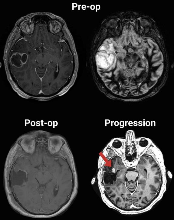 Fares et al <a href="/DrJawadFares/">Jawad Fares, MD</a> showed temporal IDH-wildtype GBM often progresses anteriorly post-resection. Anterior temporal lobectomy may reduce progression in some cases. FLAIR imaging’s predictive value is limited, urging advanced techniques.#JNO

Read more:link.springer.com/article/10.100…