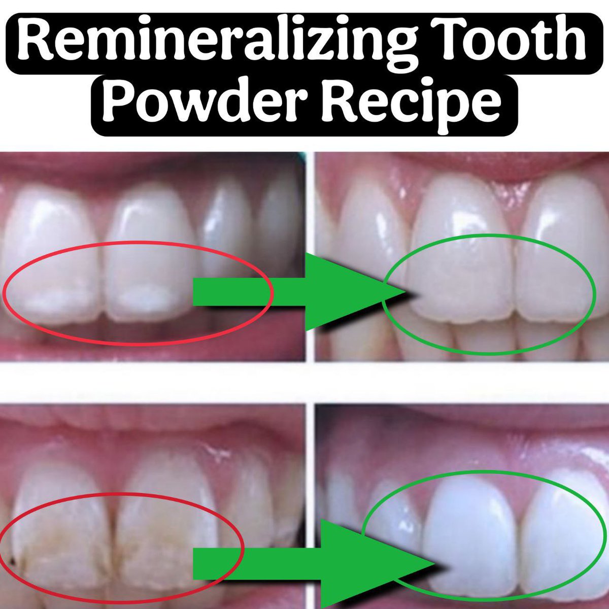 Truewareness's tweet photo. Remineralizing Tooth Powder Recipe

Ingredients
1 tsp black walnut hull powder
1 tsp horsetail powder
1 tsp baking soda
1 tsp Xylitol
1 drop peppermint essential oil

Mix these ingredients. Sprinkle ¼ teaspoon onto a wet toothbrush and brush gently twice daily morning https://t.co/5Ux39salY9