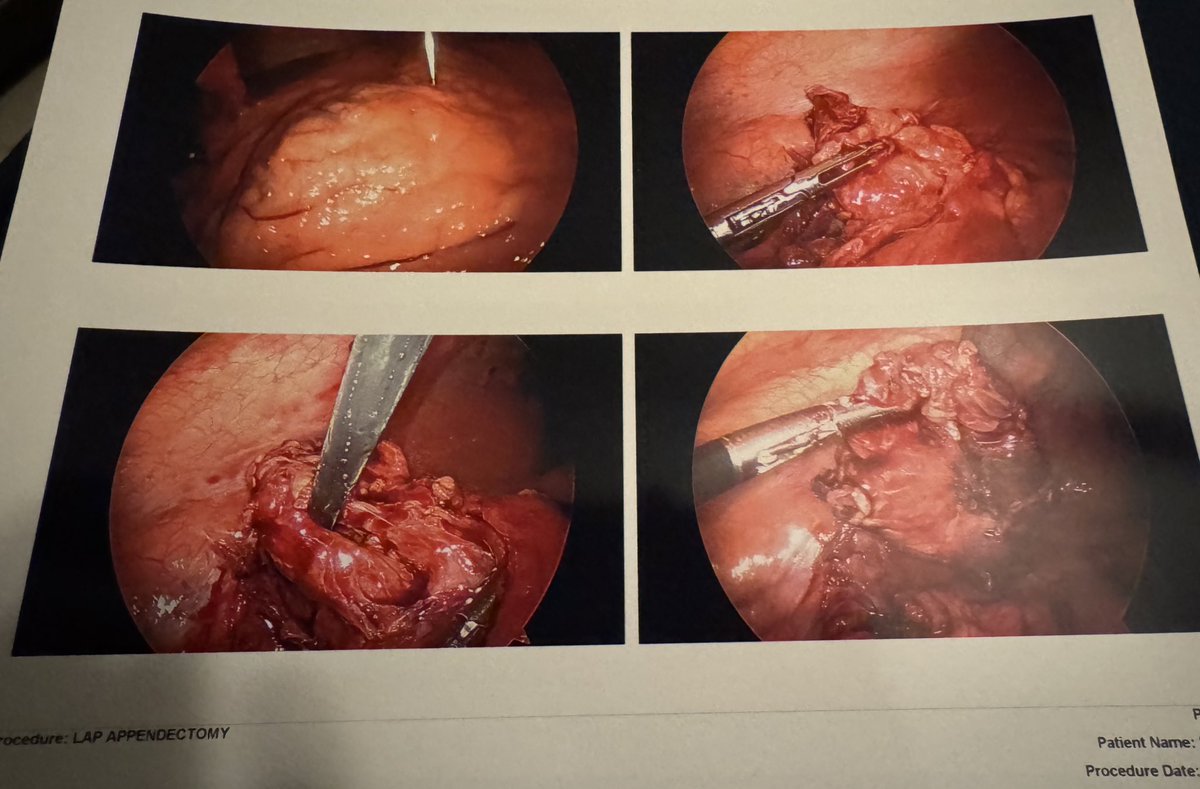 ZeroArmor's tweet photo. Had a fun weekend. Fuck you appendix. Hopefully will heal up quickly. Once the pain is more bearable I will be back streaming. Sorry for the missed streams. https://t.co/f7EhRULwgQ