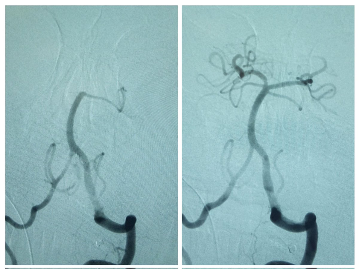 Pouria Moshayedi, MD PhD (@pouriamoshayedi) on Twitter photo Celebrating end of the Persian year with a basilar tip #thrombectomy at <a href="/TehUofMed/">Tehran University of Medical Sciences</a>
The moment of new year, March 20 9:01:30 am GMT, marks earth crossing of vernal equinox, symbol of life harmony and celebrating the gift of nature.
<a href="/SurviveStroke/">Get Ahead of Stroke</a> <a href="/treatthestroke/">Treat The Stroke</a> <a href="/MThrombectomy/">Mission Thrombectomy</a> Celebrating end of the Persian year with a basilar tip #thrombectomy at <a href="/TehUofMed/">Tehran University of Medical Sciences</a>
The moment of new year, March 20 9:01:30 am GMT, marks earth crossing of vernal equinox, symbol of life harmony and celebrating the gift of nature.
<a href="/SurviveStroke/">Get Ahead of Stroke</a> <a href="/treatthestroke/">Treat The Stroke</a> <a href="/MThrombectomy/">Mission Thrombectomy</a>