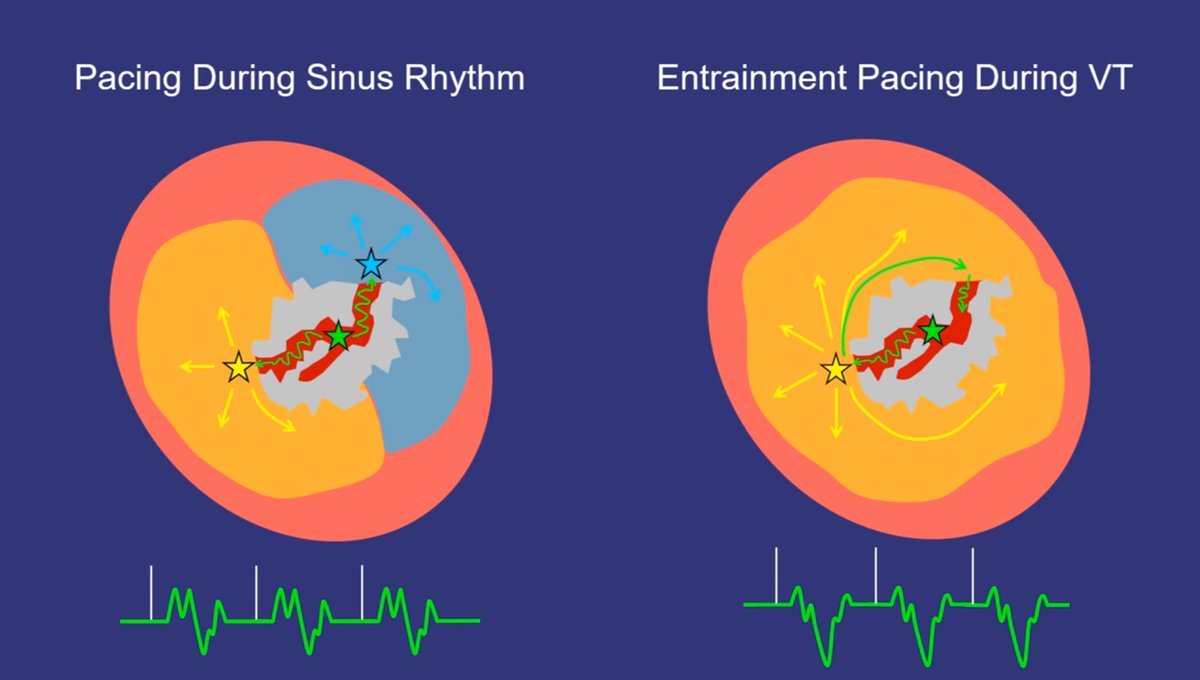 When can you Pace at the same location, at the same output, at the same speed, and predictably get different QRS morphologies?
(Spoiler alert: it depends on the presence of scar and the rhythm you are in at the time!)
#entrainment