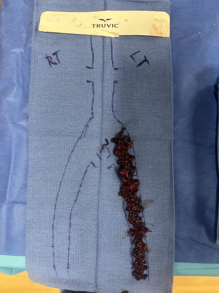 abraskin's tweet photo. Welcome to the club! Congrats to the @mercy_health Clermont team on a great first venous case with @Imperative Care Vascular’s #SymphonySystem. One pass in 20 minutes and a fantastic outcome for the patient. @FredKhosravi @PERTConsortium @JVSVL https://t.co/mgPfhWlaC1