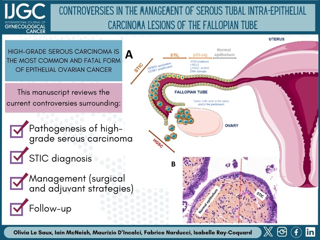 IJGC (@ijgconline) on Twitter photo #2025SpecialIssue Controversies in the management of serous tubal intra-epithelial carcinoma lesions of the #fallopiantube
✅ bit.ly/4bDVmkI
<a href="/pedroramirezMD/">Pedro T Ramirez</a> <a href="/HsuMd/">Arthur_HC_Hsu</a> <a href="/JayrajAarthi/">Aarthi S Jayraj</a> <a href="/AndreFernandes2/">Andreina Fernandes</a> <a href="/IGCSociety/">IGCS</a> <a href="/ESGO_society/">ESGO</a> <a href="/ENYGO_official/">European Network of Young Gynae Oncologists</a> <a href="/OncoAlert/">OncoAlert</a> <a href="/IJGCfellows/">IJGC Fellows</a> <a href="/GynMe4/">SoMe4GynOnc</a> #2025SpecialIssue Controversies in the management of serous tubal intra-epithelial carcinoma lesions of the #fallopiantube
✅ bit.ly/4bDVmkI
<a href="/pedroramirezMD/">Pedro T Ramirez</a> <a href="/HsuMd/">Arthur_HC_Hsu</a> <a href="/JayrajAarthi/">Aarthi S Jayraj</a> <a href="/AndreFernandes2/">Andreina Fernandes</a> <a href="/IGCSociety/">IGCS</a> <a href="/ESGO_society/">ESGO</a> <a href="/ENYGO_official/">European Network of Young Gynae Oncologists</a> <a href="/OncoAlert/">OncoAlert</a> <a href="/IJGCfellows/">IJGC Fellows</a> <a href="/GynMe4/">SoMe4GynOnc</a>