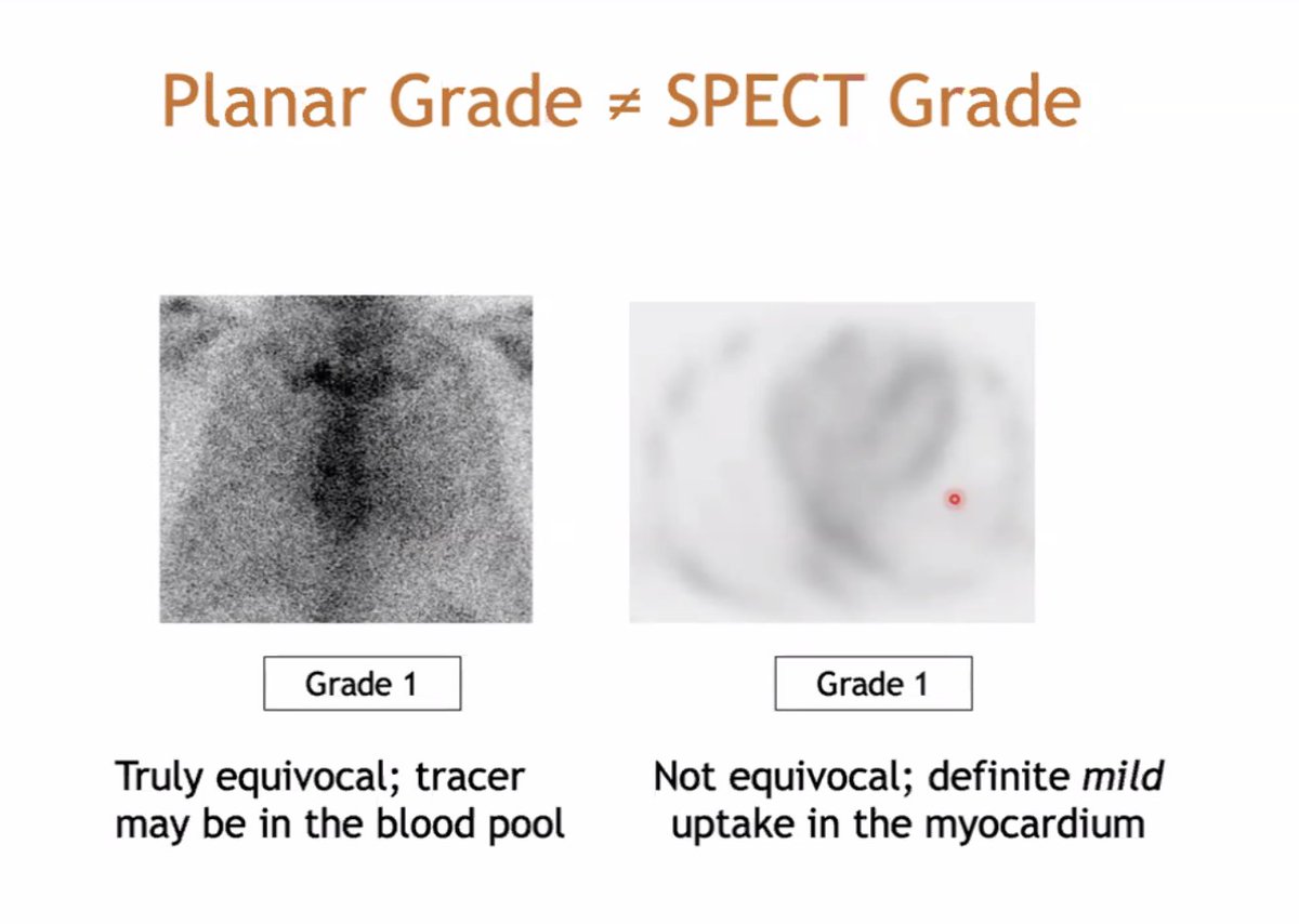 A.Sami Abuzaid MD,EMHL,FASE,FSCCT,FSCMR,FESC,FACC (@aabuzaiddr) on Twitter photo Tips and tricks for ATTR SPECT imaging.
👇do not depend on planar -->Do SPECT
🫵 PYP uptake can be patchy or diffuse
✍️ Expect wash out with HMDP and scan at 1 hour
<a href="/MyASNC/">ASNC Society</a> #CVNuc <a href="/premsoman123/">Prem Soman</a> <a href="/NotNoninvasive/">Saurabh Malhotra</a> Tips and tricks for ATTR SPECT imaging.
👇do not depend on planar -->Do SPECT
🫵 PYP uptake can be patchy or diffuse
✍️ Expect wash out with HMDP and scan at 1 hour
<a href="/MyASNC/">ASNC Society</a> #CVNuc <a href="/premsoman123/">Prem Soman</a> <a href="/NotNoninvasive/">Saurabh Malhotra</a>