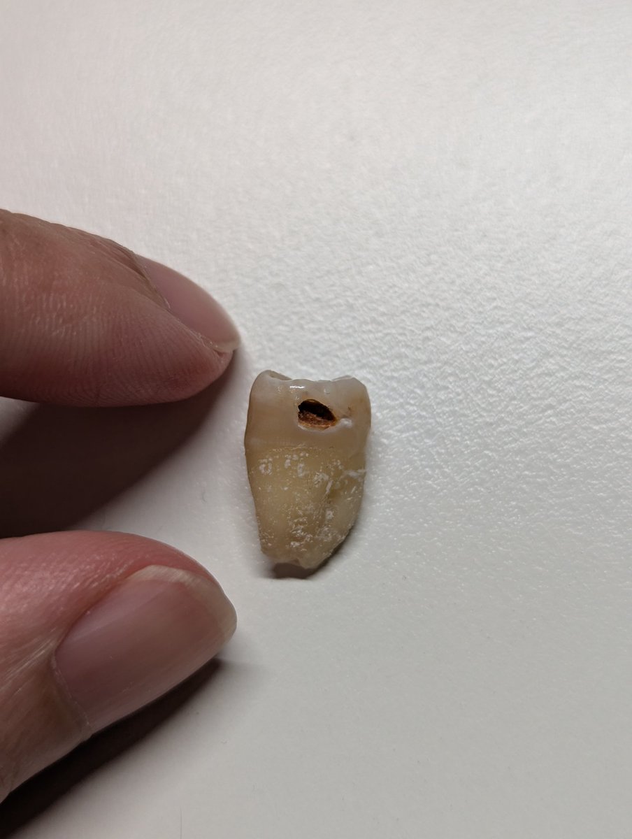 終於去處理蛀牙的智齒ㄌ~~~
確實有被這個洞嚇到🥹
回想了一下，應該是幾年前被牙醫朋朋說服幫我補牙而鑽出來的洞，可能他覺得我智齒長得很端正，拔掉可惜（？）。
但是去年某次用牙線時，不小心把補料掏了出來，就這樣過了一年......