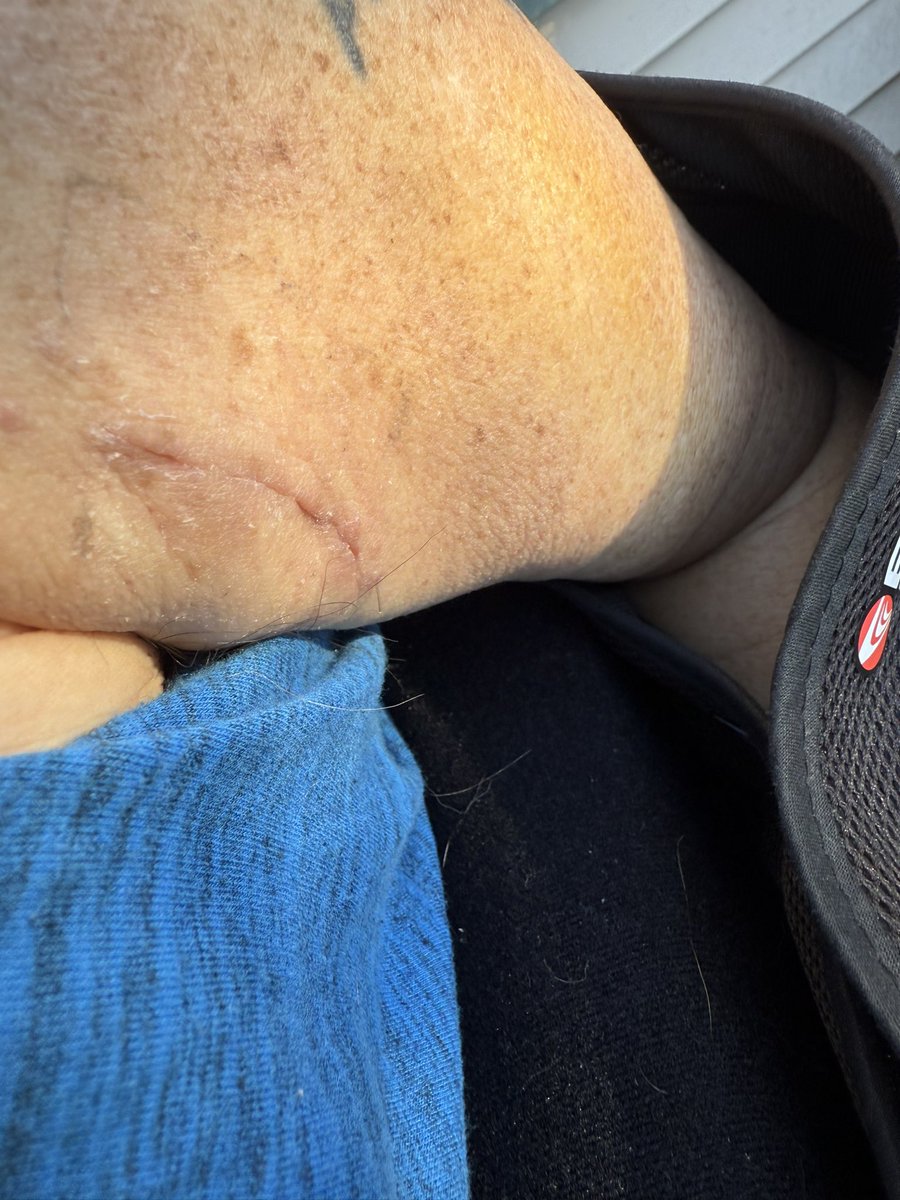 Today was two week check in with Doc, stitches look good and #PT went well yesterday.  #shouldersurgery #recovery