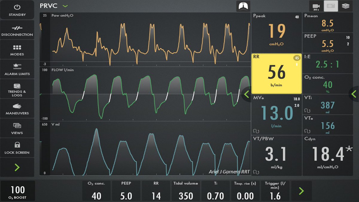 Ariel J Garnero (@arielg_rrt) on Twitter photo You happen to be in the unit while 2 code blue are happening. Nurses are busy. What would you do for this pt until the nurse bolus a sedative? <a href="/DocMusician/">Doc Musician</a> <a href="/DrMiguelIbarra1/">Dr. Miguel Ibarra-Estrada</a> <a href="/emireles_c/">Eduardo Mireles-Cabodevila</a> <a href="/CCF_PCCM/">CCF Pulmonary and Critical Care Fellows</a> <a href="/IM_Crit_/">IMCrit</a> <a href="/critconcepts/">Critical Concepts</a> <a href="/OfVentilation/">Society of Mechanical Ventilation</a> <a href="/Vent_Busters/">VentBusters</a> <a href="/RagingRenals/">Albert Bui</a> <a href="/respitroy/">Troy Whitacre</a> You happen to be in the unit while 2 code blue are happening. Nurses are busy. What would you do for this pt until the nurse bolus a sedative? <a href="/DocMusician/">Doc Musician</a> <a href="/DrMiguelIbarra1/">Dr. Miguel Ibarra-Estrada</a> <a href="/emireles_c/">Eduardo Mireles-Cabodevila</a> <a href="/CCF_PCCM/">CCF Pulmonary and Critical Care Fellows</a> <a href="/IM_Crit_/">IMCrit</a> <a href="/critconcepts/">Critical Concepts</a> <a href="/OfVentilation/">Society of Mechanical Ventilation</a> <a href="/Vent_Busters/">VentBusters</a> <a href="/RagingRenals/">Albert Bui</a> <a href="/respitroy/">Troy Whitacre</a>