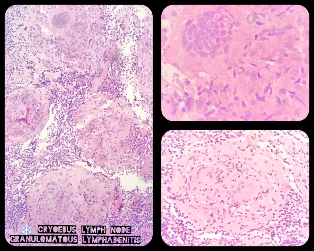 ❄️ CryoEBUS - mediastinal lymph node - indications:
3️⃣ Level.  Metastatic Non Small Cell Carcinoma. 🧬 Need for molecular testing.
4️⃣ Level.  Miscellaneous.  Inflammatory diseases.
🆓 Access: pubmed.ncbi.nlm.nih.gov/39837131/

#LungPath #PulmPath