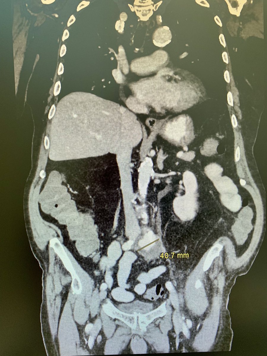 #idxposts here is 91y male patient. 7 days of a MSSA bacteremia. Current on Ampicillin/Sulbactam. BKs have cleaned up when I was first called. What do you see? How would you manage it? 😉