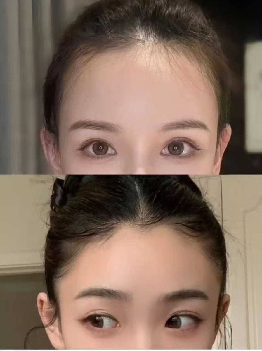 yumi_casaceo's tweet photo. 額......
額...........大事‼️
額です出来る事は
額縮小、ヘアライン植毛。 https://t.co/dnhKCG55Fh