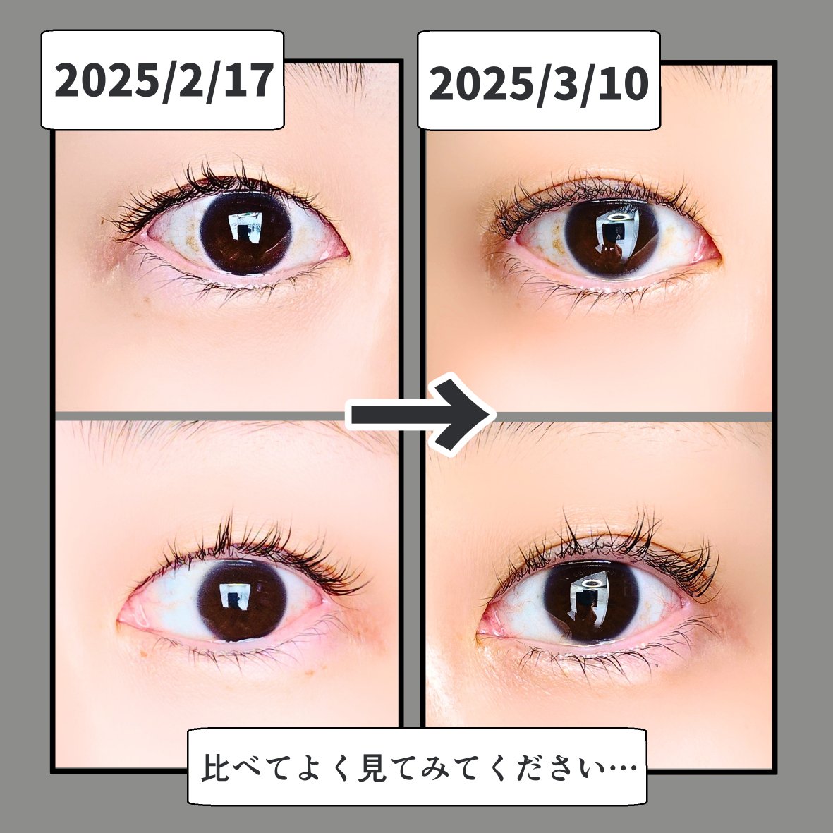 KT7531825366936's tweet photo. #PR soaddict様(@soaddicted_jp)
2025 2/17〜3/10まで塗り続けた報告！全体的に長さが出た？(続↓)
#forcise #ラッシュアディクト #Lashaddict #ラッシュアディクトアドバンス #まつげ美容液 #まつ毛美容液 #アイラッシュ #アイケア #リニューアル #beautypark_shop #monipla #forcise_fan https://t.co/OIGrJ4K2hB