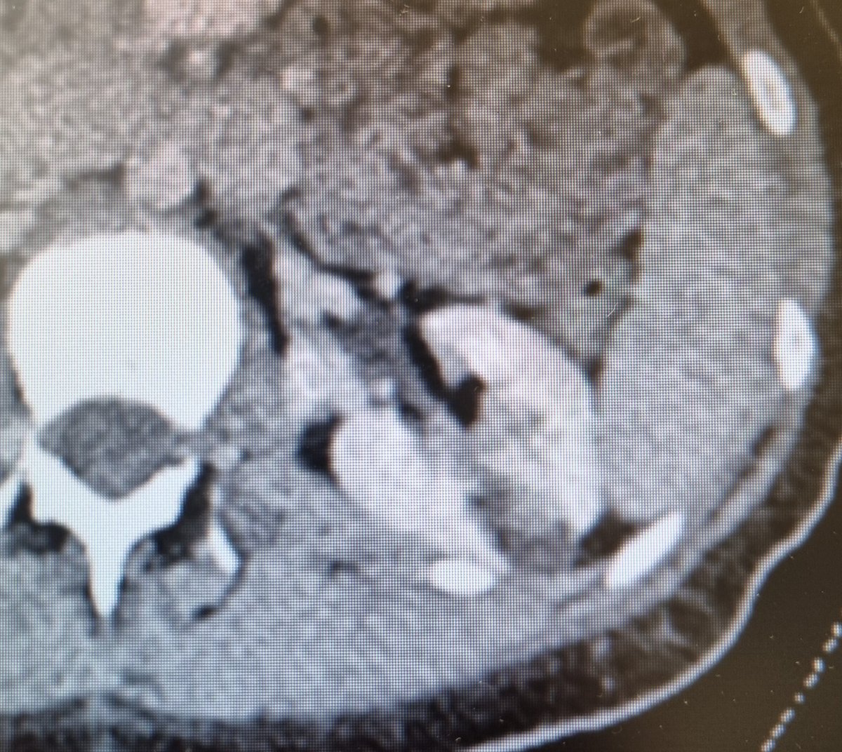 Marcos Cepeda (@drmarcoscepeda) on Twitter photo Workshop on robot-assisted #retroperitoneoscopic partial nephrectomy at #HURH
- endophitic T1a
- T1b in single kidney
Congrats to my team for the effort! <a href="/CoralManso/">Coral Manso Aparicio</a> <a href="/ppalaciov/">Pablo Palacio V.</a> <a href="/kikegonzalez11/">Enrique G. MD</a>
Thanks to <a href="/abexDaVinci/">ABEX Excelencia Robótica</a> for the support
#teamwork
#teaching
#RAPN Workshop on robot-assisted #retroperitoneoscopic partial nephrectomy at #HURH
- endophitic T1a
- T1b in single kidney
Congrats to my team for the effort! <a href="/CoralManso/">Coral Manso Aparicio</a> <a href="/ppalaciov/">Pablo Palacio V.</a> <a href="/kikegonzalez11/">Enrique G. MD</a>
Thanks to <a href="/abexDaVinci/">ABEX Excelencia Robótica</a> for the support
#teamwork
#teaching
#RAPN