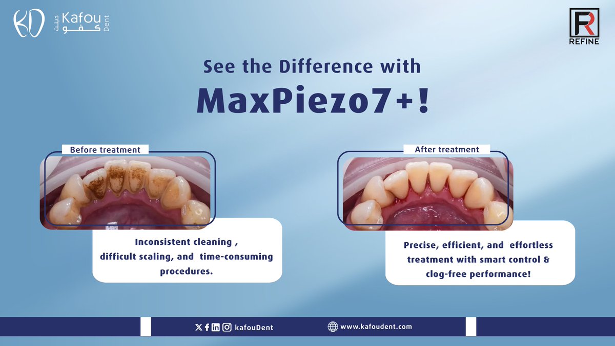 KafouDent's tweet photo. Revolutionize your dental treatments with MaxPiezo7+.
No more struggling with stubborn plaque or inefficient scaling.
Deliver faster, smoother, and more precise results with advanced ultrasonic technology.
Elevate your clinic’s performance. https://t.co/B2QxL2mJBb