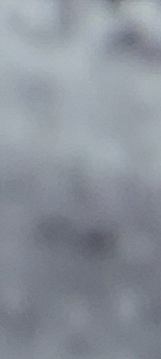 Here's a zoomed pic of my penise's broken tunica albuginea