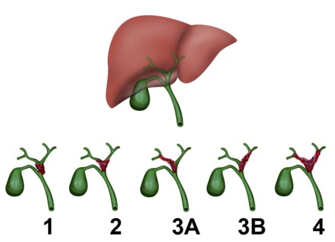 Bismuth Corlette classification for hilar Cholangiocarcinoma. <a href="/juliomayol/">Julio Mayol</a> <a href="/TomVargheseJr/">Tom Varghese Jr. MD, MS, MBA, FACS, MAMSE 🇺🇸</a>