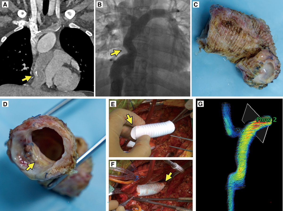 European Society of Cardiology Journals (@esc_journals) on Twitter photo Fontan circulatory failure: a case report of re-operation treatment of vascular graft angulation stenosis. doi.org/10.1093/ehjcr/…
#EHJCaseReports <a href="/Phiso_de/">Philipp Sommer</a> <a href="/TJ_Yeo/">Tee Joo YEO</a> <a href="/aayshacader/">Aaysha Cader</a> <a href="/BoldiKovacsMD/">Boldizsar Kovacs</a> <a href="/KardiologieHH/">Erik Rafflenbeul</a> <a href="/ANazmiCalik/">A.Nazmi Calik</a> <a href="/O_Azizy_MD/">Obayda Azizy</a> <a href="/saramoscatelli7/">Sara Moscatelli</a> <a href="/EHJCREiC/">EHJCaseReports Editor-in-Chief</a> #CardioX Fontan circulatory failure: a case report of re-operation treatment of vascular graft angulation stenosis. doi.org/10.1093/ehjcr/…
#EHJCaseReports <a href="/Phiso_de/">Philipp Sommer</a> <a href="/TJ_Yeo/">Tee Joo YEO</a> <a href="/aayshacader/">Aaysha Cader</a> <a href="/BoldiKovacsMD/">Boldizsar Kovacs</a> <a href="/KardiologieHH/">Erik Rafflenbeul</a> <a href="/ANazmiCalik/">A.Nazmi Calik</a> <a href="/O_Azizy_MD/">Obayda Azizy</a> <a href="/saramoscatelli7/">Sara Moscatelli</a> <a href="/EHJCREiC/">EHJCaseReports Editor-in-Chief</a> #CardioX