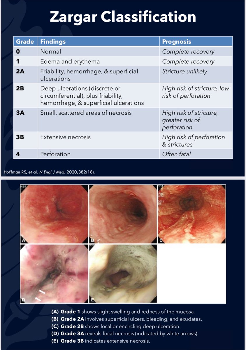 We had an excellent esophageal conference on the management of caustic ingestion presented by chief fellow Dr. Nguyen ✨

Zargar Classification (Endoscopic grading):
⬆️grade assoc. with ⬆️ risk of stricture formation &amp; perf!

2B+: EGD for SCC screen q2-3y after 10y of ingestion