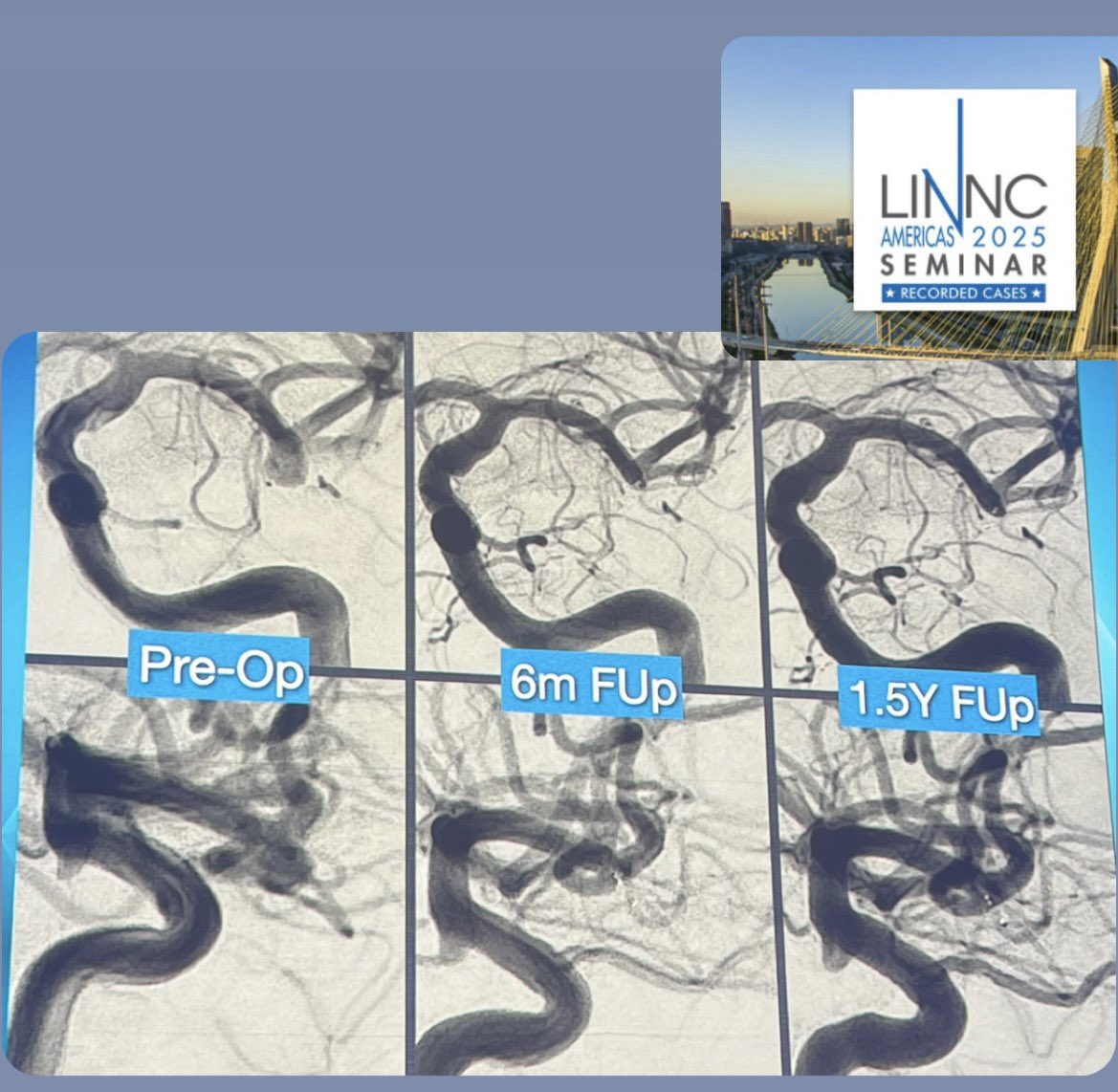 Jessica Campos, MD (@drjessicacampos) on Twitter photo Kicking off #LINNCAmericas with the pre-conference workshop on treating complex aneurysms - a master class taught by the Course Directors, with an education grant by <a href="/LINNConline/">LINNC online 🧠</a> <a href="/terumoneuro/">Terumo Neuro</a> Kicking off #LINNCAmericas with the pre-conference workshop on treating complex aneurysms - a master class taught by the Course Directors, with an education grant by <a href="/LINNConline/">LINNC online 🧠</a> <a href="/terumoneuro/">Terumo Neuro</a>