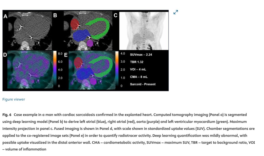 Journal of Nuclear Cardiology (@jncjournal) on Twitter photo Fully automated volumetric quantification of FDG PET for cardiac sarcoidosis based on CT attenuation map-derived volumetry is feasible, rapid, and has high prediction performance. <a href="/robertjhmiller/">Robert Miller</a> <a href="/UCalgary/">U Calgary</a> <a href="/Piotr_JSlomka/">Piotr Slomka PhD</a> <a href="/SmidtHeart/">Smidt Heart Institute at Cedars-Sinai</a>
Read here👉bit.ly/4hKBoGf
#cvnuc Fully automated volumetric quantification of FDG PET for cardiac sarcoidosis based on CT attenuation map-derived volumetry is feasible, rapid, and has high prediction performance. <a href="/robertjhmiller/">Robert Miller</a> <a href="/UCalgary/">U Calgary</a> <a href="/Piotr_JSlomka/">Piotr Slomka PhD</a> <a href="/SmidtHeart/">Smidt Heart Institute at Cedars-Sinai</a>
Read here👉bit.ly/4hKBoGf
#cvnuc