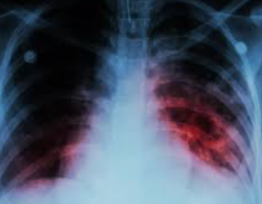 #URGENTE OFICIAL:

TUBERCULOSIS MÉXICO:
380 casos confirmados última semana
4113 casos confirmados en lo que va de 2025.
Hay alerta internacional de OMS.
Vivo en <a href="/nmasforo/">N+ FORO</a>