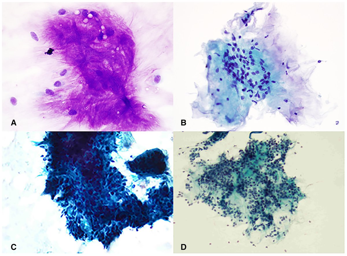 Cancer Cytopathology (@cancercytopath) on Twitter photo Wind down #USCAP2025 with tonight's Evening Specialty Conference at 6pm—Reporting Systems in Cytopathology: Perspectives From the Experts, featuring our very own Associate Editor <a href="/DianaEstherossi/">Esther Diana Rossi</a>!
Read some of her past work on the #MilanSystem: acsjournals.onlinelibrary.wiley.com/doi/10.1002/cn…
#CytoPath Wind down #USCAP2025 with tonight's Evening Specialty Conference at 6pm—Reporting Systems in Cytopathology: Perspectives From the Experts, featuring our very own Associate Editor <a href="/DianaEstherossi/">Esther Diana Rossi</a>!
Read some of her past work on the #MilanSystem: acsjournals.onlinelibrary.wiley.com/doi/10.1002/cn…
#CytoPath