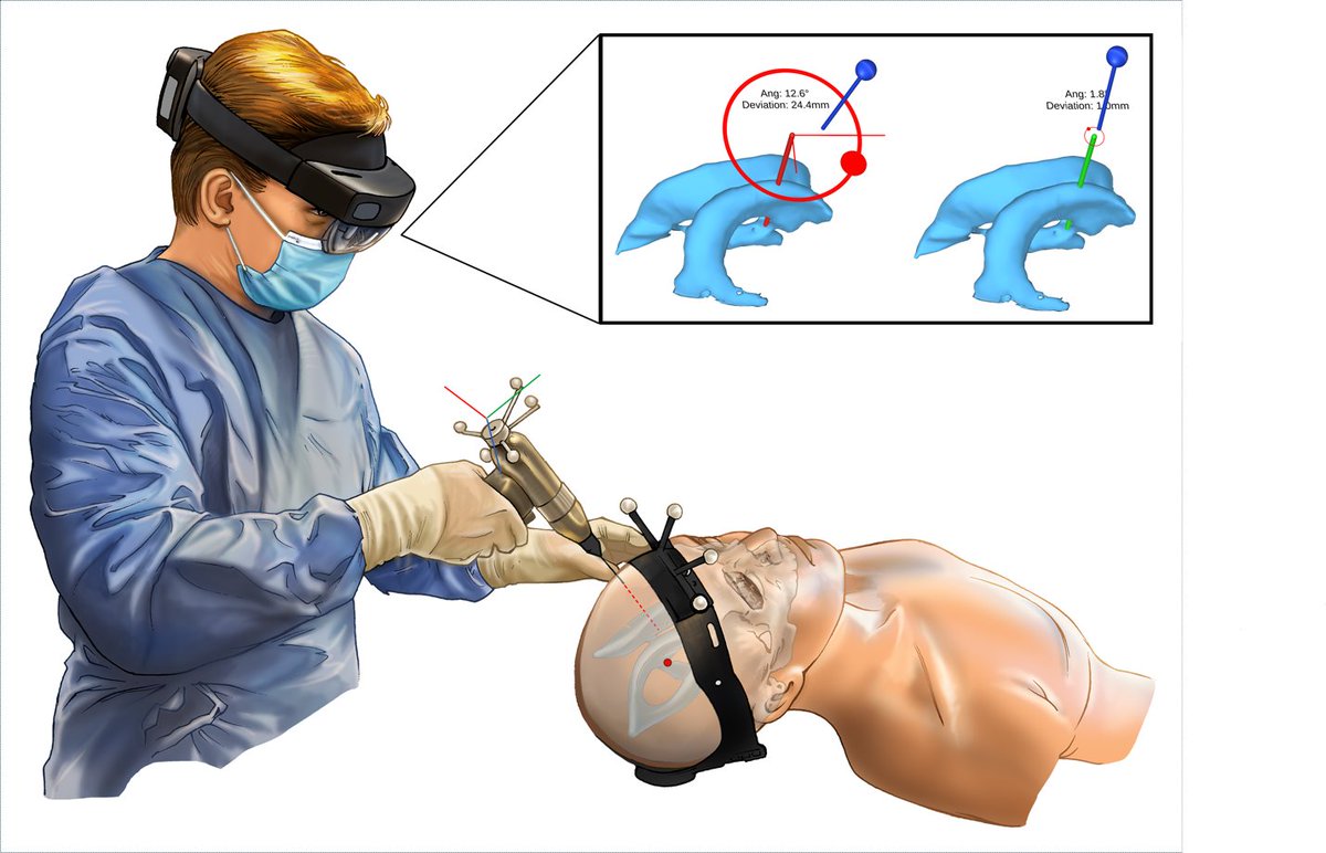 neurosurgery's tweet photo. NEW on #NeurosurgeryBlog! Cross-Post: High-Accuracy Augmented Reality Guidance for Intracranial Drain Placement Using a Standalone Head-Worn Navigation System: First-in-Human Results.

Read more 👉 https://t.co/RLJqgJAWw5 @NeurosurgeryCNS https://t.co/nT6BBGrVjA