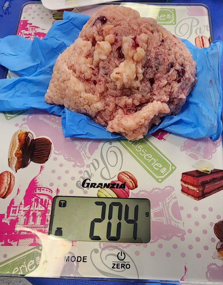 mahmoud nabil laymon (@mahmoudlaimon) on Twitter photo Today's case: 73-year old gentelman presented with acute urine retention. Very large prostate 220 gm. #HoLEP has no size limits. I am very grateful to the great mentors <a href="/fgomsan/">Fernando GomezSancha</a> <a href="/KarinLehrich/">Karin Lehrich</a> Today's case: 73-year old gentelman presented with acute urine retention. Very large prostate 220 gm. #HoLEP has no size limits. I am very grateful to the great mentors <a href="/fgomsan/">Fernando GomezSancha</a> <a href="/KarinLehrich/">Karin Lehrich</a>
