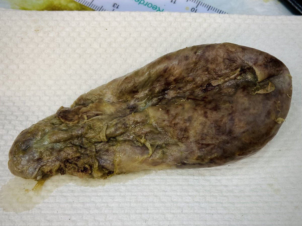#GrossWordWednesday

This #gallbladder is Mottled. Mottled means having uneven, discolored patches. It is similar to Variegated or Heterogenous, except that the term mottled is used more often when the borders between the colors are smeared or blurry. A Mottled appearance is also