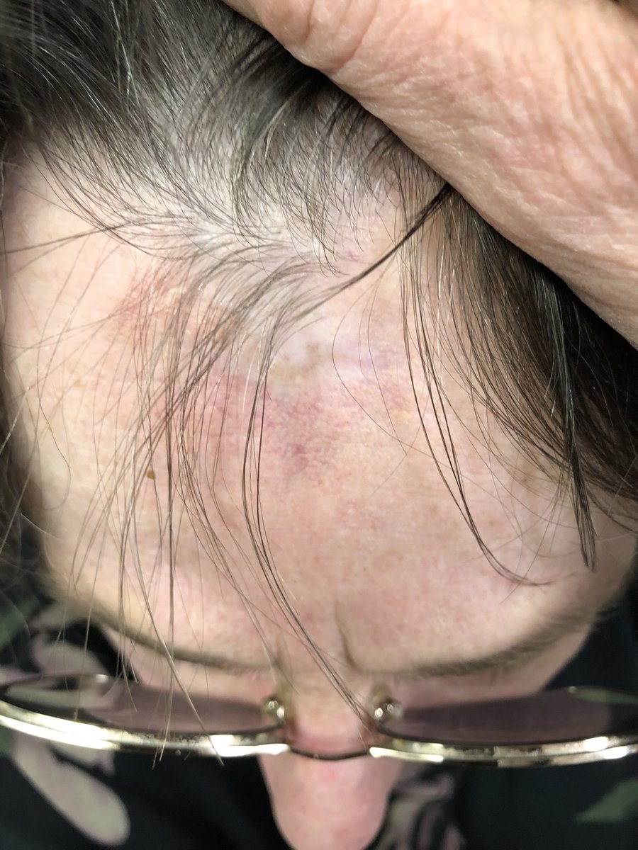 Janetbirdope's tweet image. #Discoid #lupus

Scarring, damage to hair follicles 

👇
-10% have #systemic #SLE

Lesions often expand over time 

#ClinicalPearl
#Diagnosis in 3 #pictures 

#MedEd #MedX #DermEd #DermX
#RheumEd #RheumX