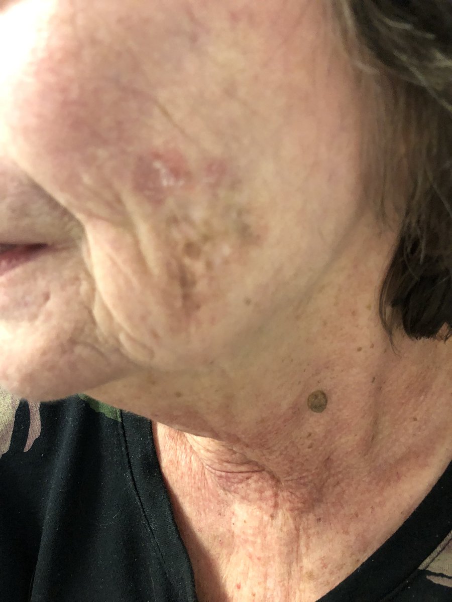 Janetbirdope's tweet image. #Discoid #lupus

Scarring, damage to hair follicles 

👇
-10% have #systemic #SLE

Lesions often expand over time 

#ClinicalPearl
#Diagnosis in 3 #pictures 

#MedEd #MedX #DermEd #DermX
#RheumEd #RheumX