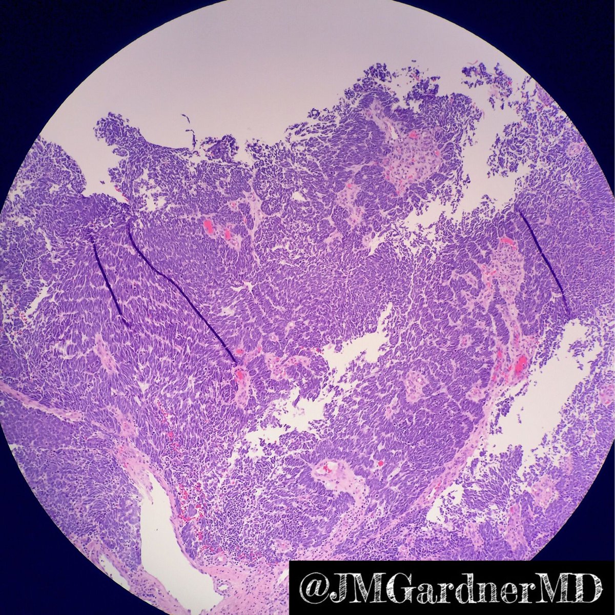 Skin nodule in elderly adult. Diagnosis? 
Hint: as Shakespeare said, “All that palisades is not schwannoma!” 
Answer ✅ youtu.be/zq51HMJNoZ4?si…
#pathology #pathologists #pathTwitter #dermpath #dermatology #dermatologia #dermtwitter