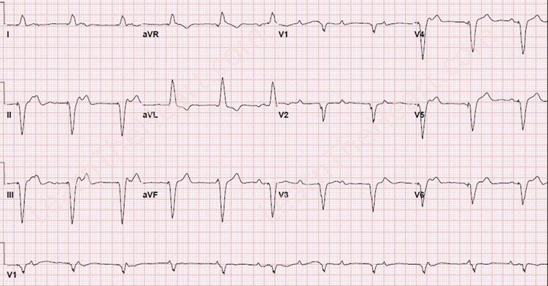 LearntheHeart's tweet photo. #ECGoftheWeek 

What is your interpretation of this ECG? Cast your vote below and check back Friday for the answer. https://t.co/hqgsvF3yyi
