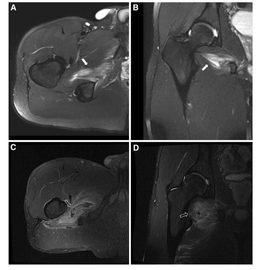 Injuries of the obturator muscles in professional soccer players
doi: 10.1007/s00167-017-4453-6.

This study investigated the prevalence and characteristics of obturator muscle injuries in professional soccer players. Data from four first-division Spanish soccer teams over four